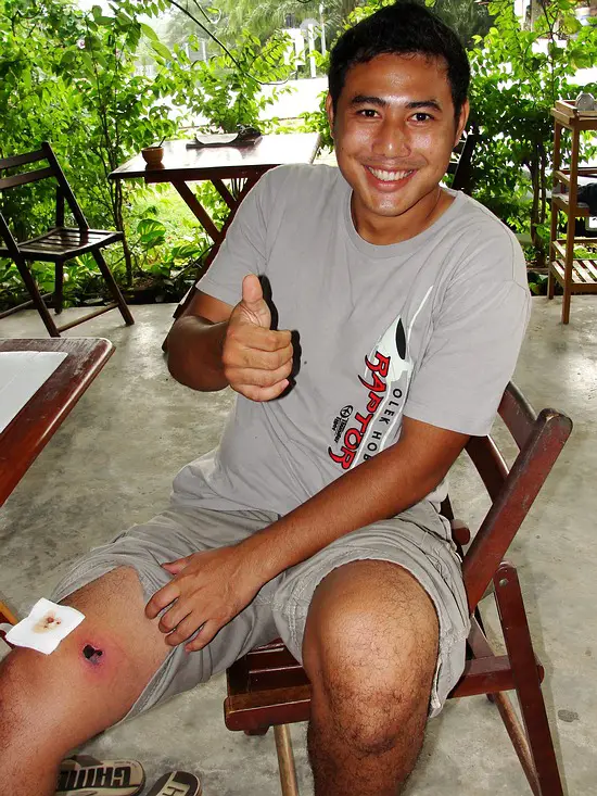 Snake show presenter after a monocled cobra bite showing deep necrosis at the snakebite site.